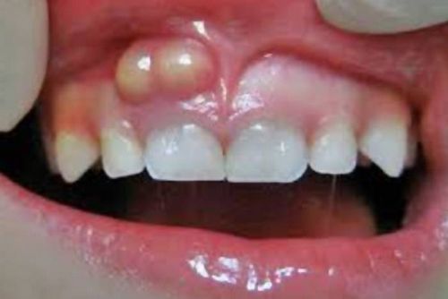 Abses Gigi dan Antibiotik Oral gigi yang ada dengan