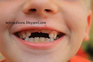 Cara Mencegah Kerusakan Gigi menyikat flos akan menghilangkan
