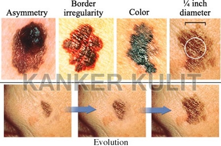 Seperti Apa Bentuk Kanker Kulit - Yang Harus Diperhatikan kulit dikenal